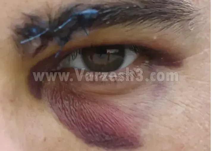 هاله بنفش صورت سروش را فرا گرفت! (عکس)